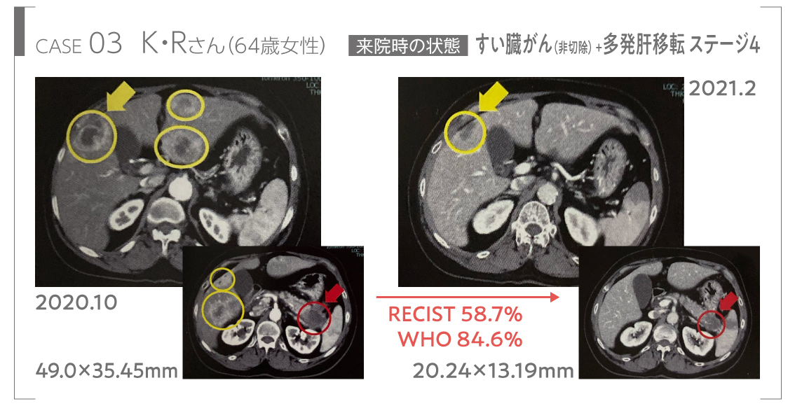 すい臓がんと多発肝移転ステージ4からの回復のビフォーアフターの画像