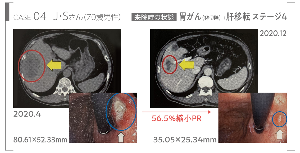胃がん（非切除） +肝移転 ステージ4からの回復のビフォーアフターの画像